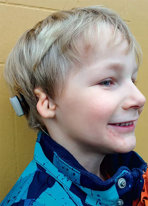 Figura-2-artesia-oido-izquierdo