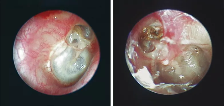 fifuras-1-2-Colesteatoma-GA