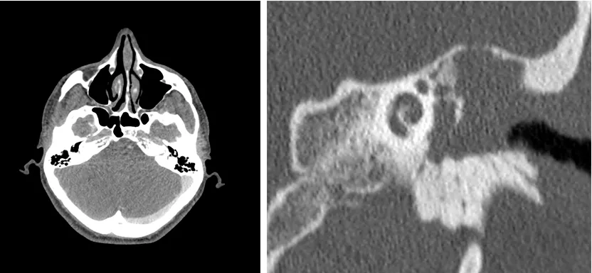 figuras-6-7-Colesteatoma-GA