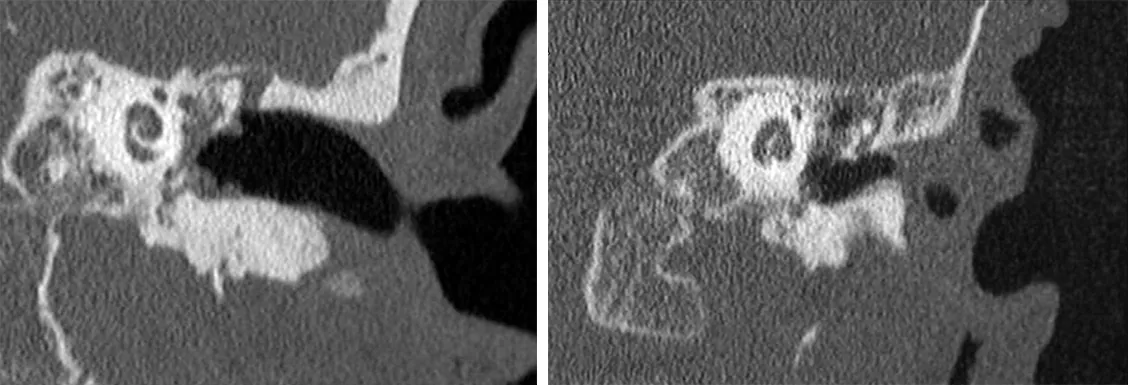 fuguras-3-4-Colesteatoma-GA